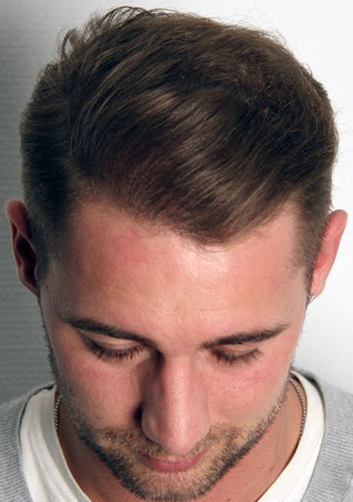 Hair Transplant After