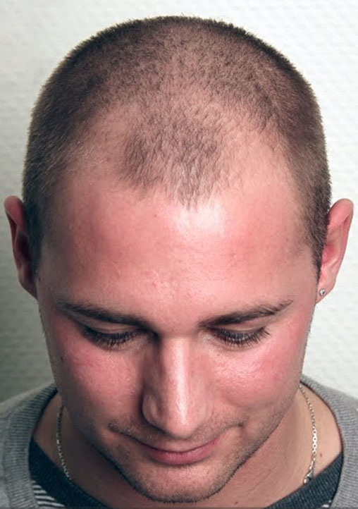 Hair Transplant Before